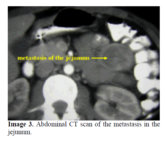pancreas-CT-scan-the-metastasis