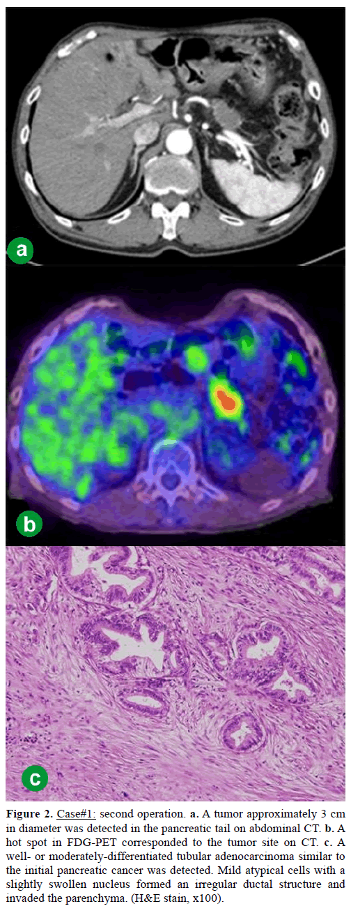 pancreas-Case1-second-operation