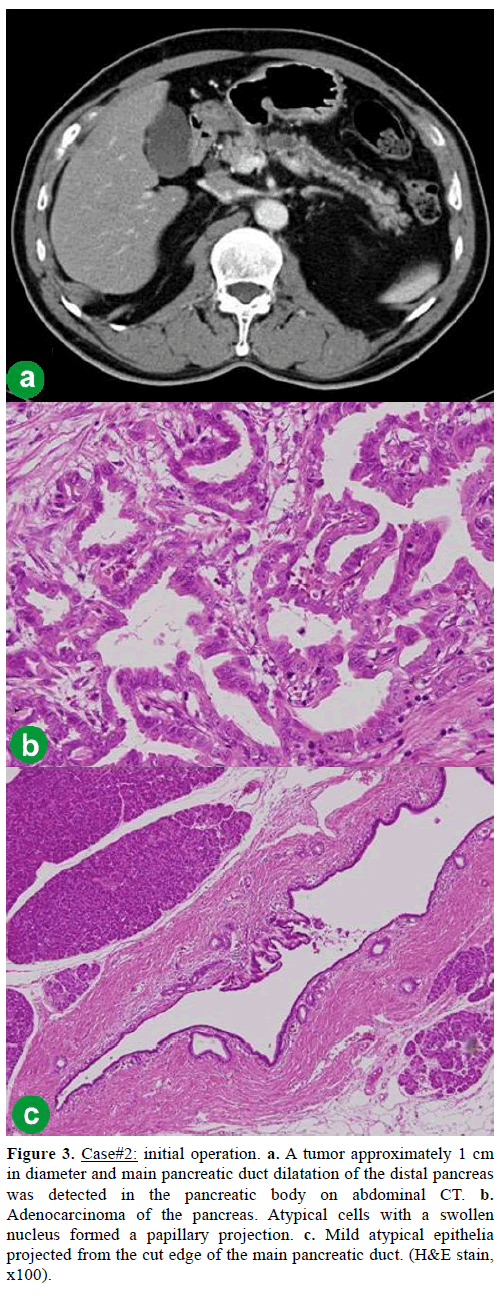 pancreas-Case2-initial-operation