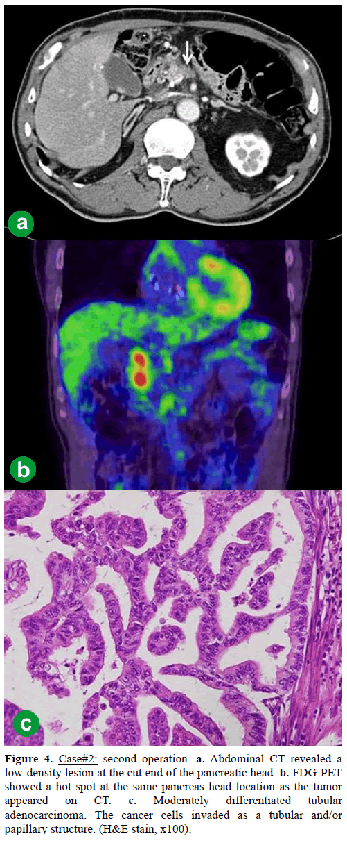 pancreas-Case2-second-operation