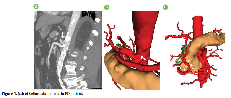 pancreas-Celiac-axis-stenosis