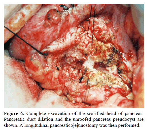 pancreas-Complete-excavation-duct-dilation