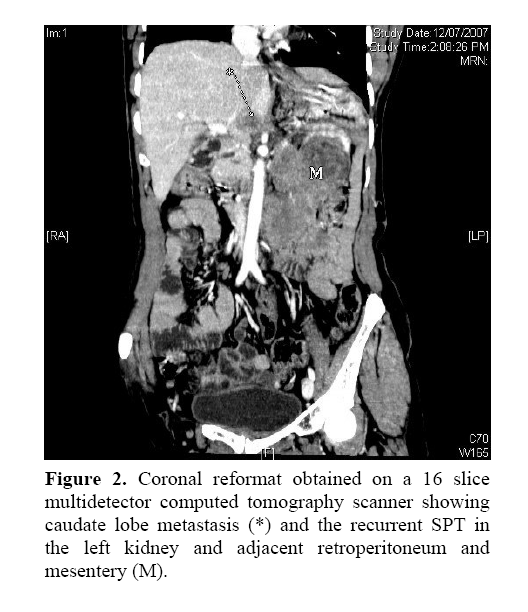 pancreas-Coronal-reformat-obtained