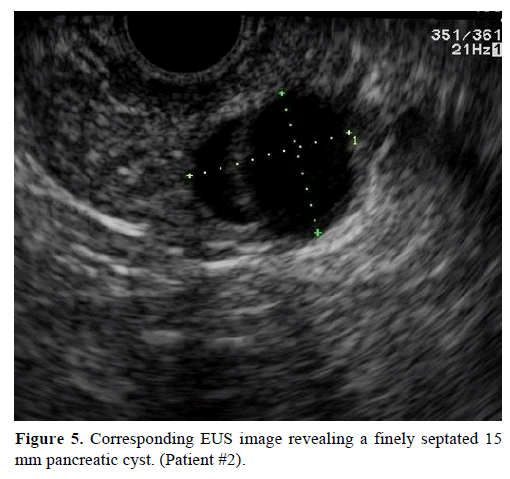 pancreas-Corresponding-eus-image