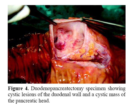 pancreas--Duodenopancreatectomy-specimen
