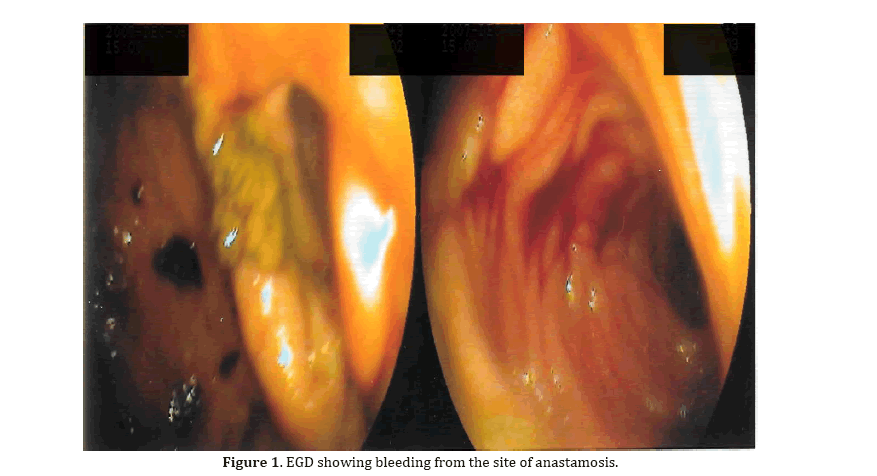 pancreas-EGD-showing-bleeding