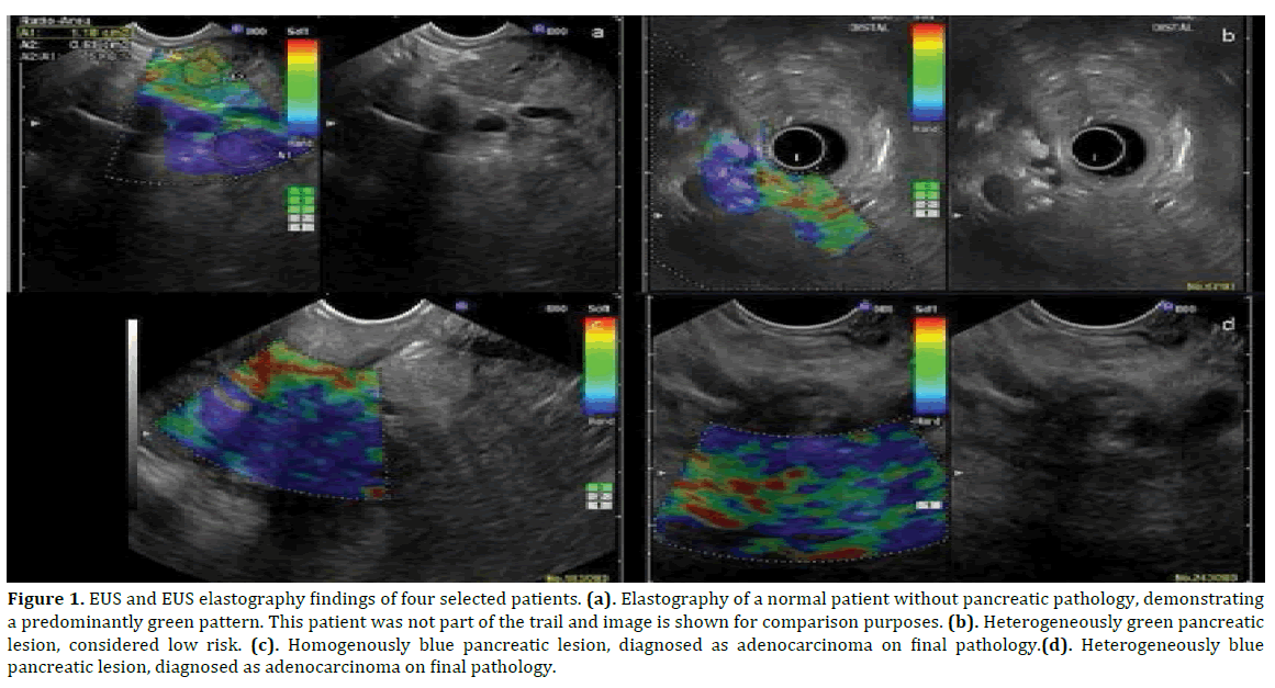 pancreas-Elastography-normal-patient