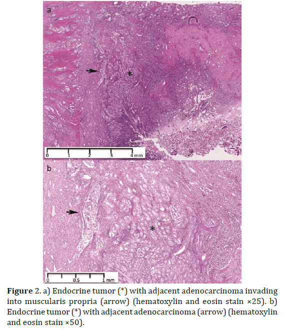 pancreas-Endocrine-tumor-adenocarcinoma