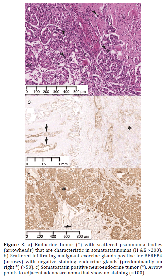 pancreas-Endocrine-tumor-scattered-psammoma