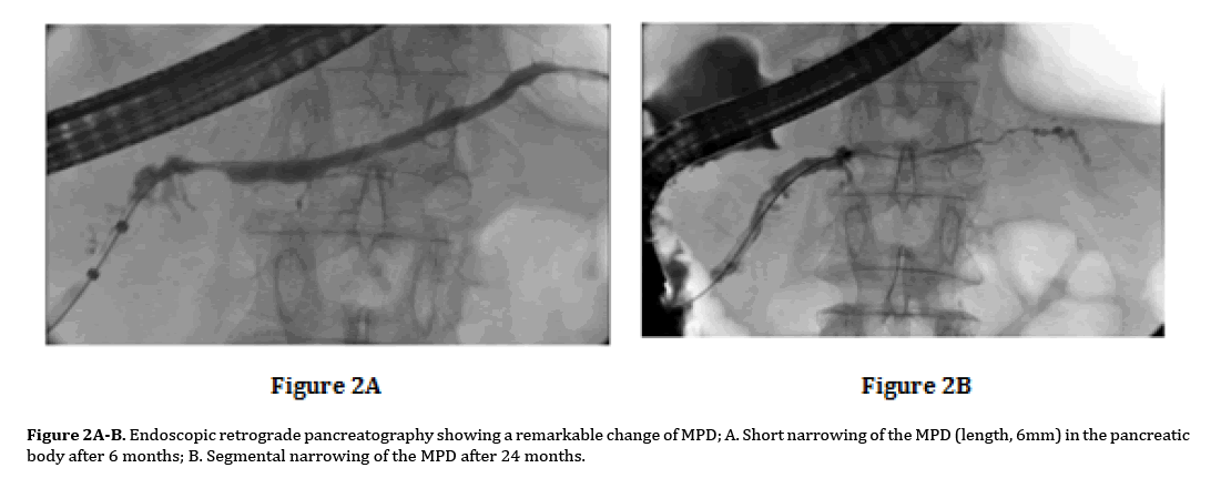 pancreas-Endoscopic-retrograde-pancreatography