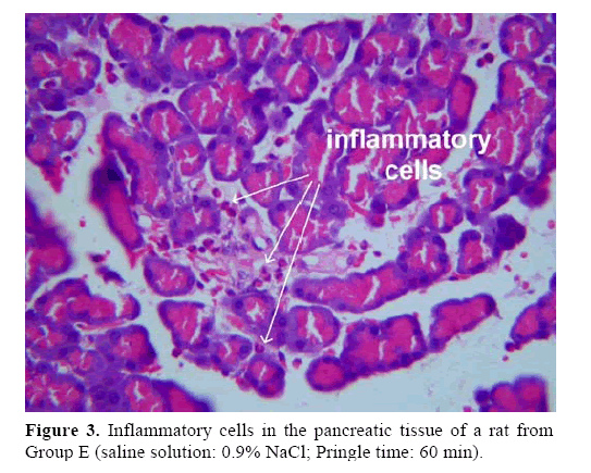 pancreas-Inflammatory-cells