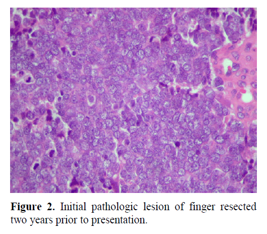 pancreas-Initial-pathologic-lesion