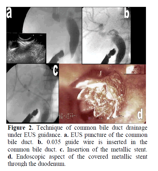 pancreas-Insertion-metallic-stent