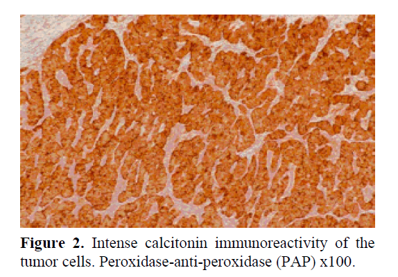 pancreas-Intense-calcitonin-immunoreactivity