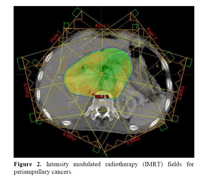 pancreas-Intensity-modulated-radiotherapy