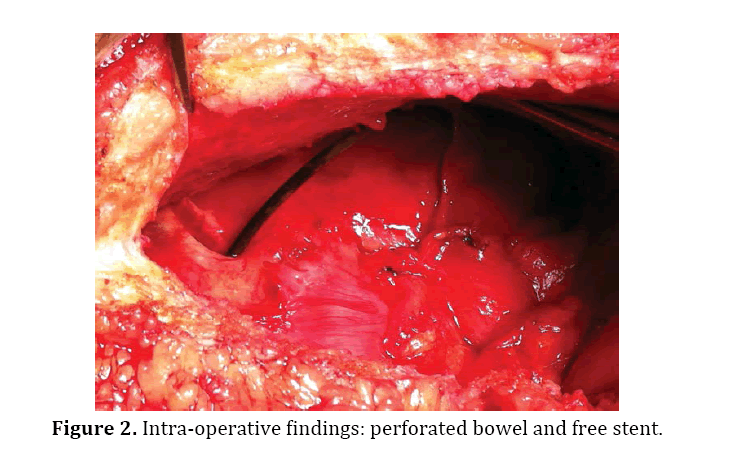 pancreas-Intra-operative-findings