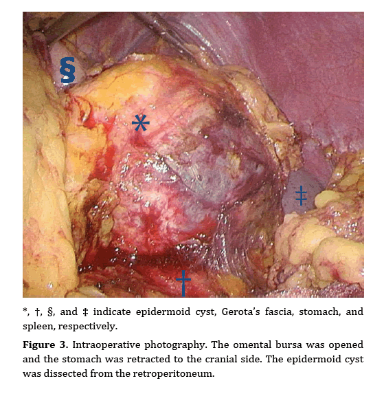 pancreas-Intraoperative-photography