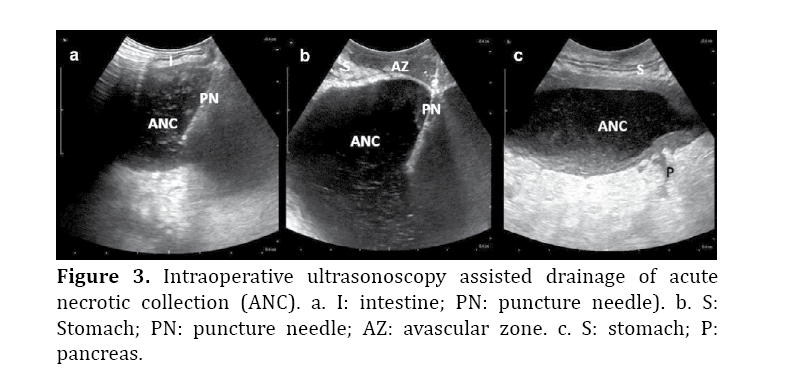 pancreas-Intraoperative-ultrasonoscopy