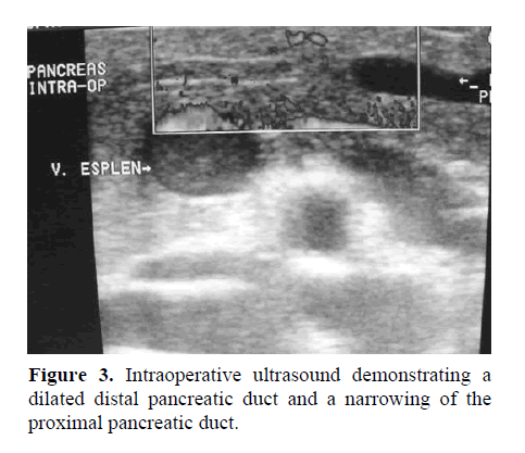 pancreas-Intraoperative-ultrasound-demonstrating