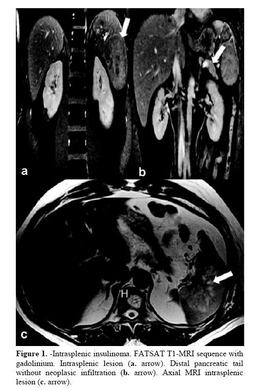 pancreas-Intrasplenic-insulinoma