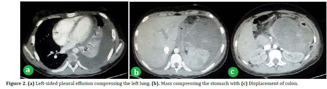 pancreas-Left-sided