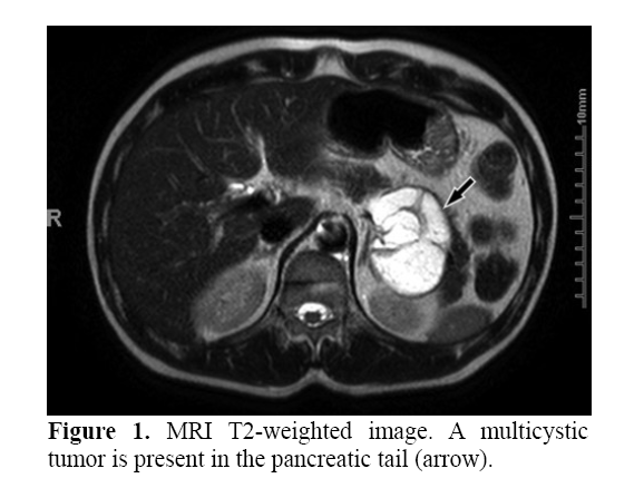 pancreas-MRI-T2-weighted-image