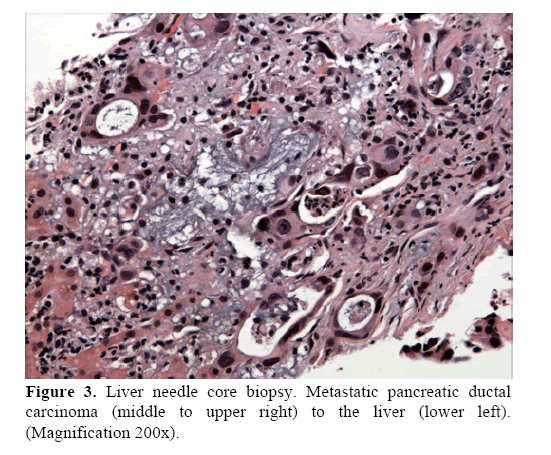 pancreas-Metastatic-pancreatic