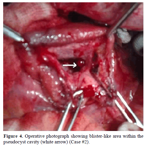 pancreas-Operative-photograph