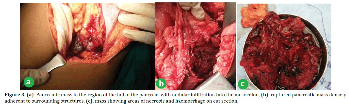 pancreas-Pancreatic-mass