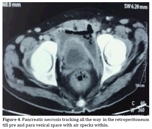 pancreas-Pancreatic-necrosis-tracking