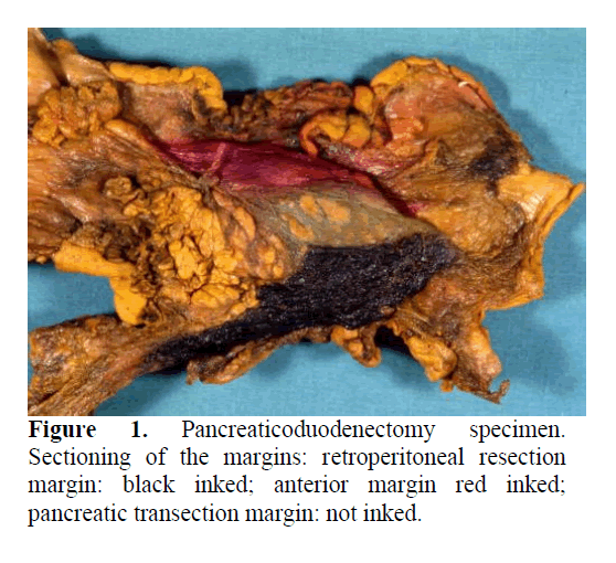 pancreas-Pancreaticoduodenectomy-specimen