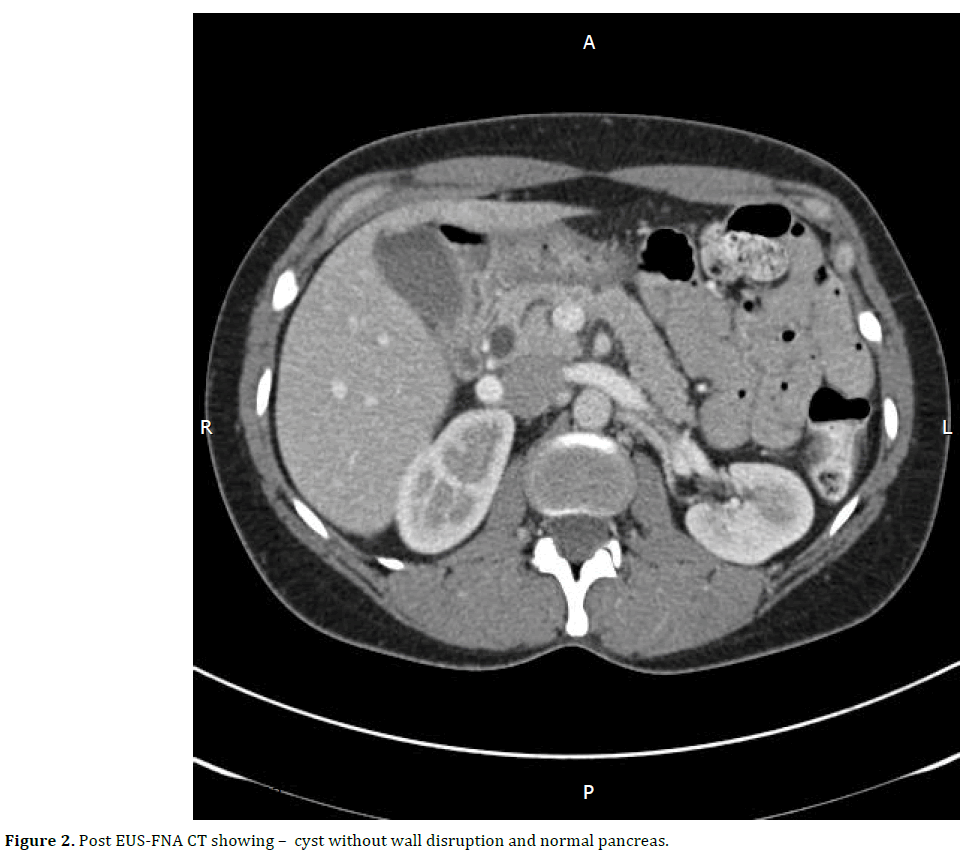 pancreas-Post-eus-fna-disruption