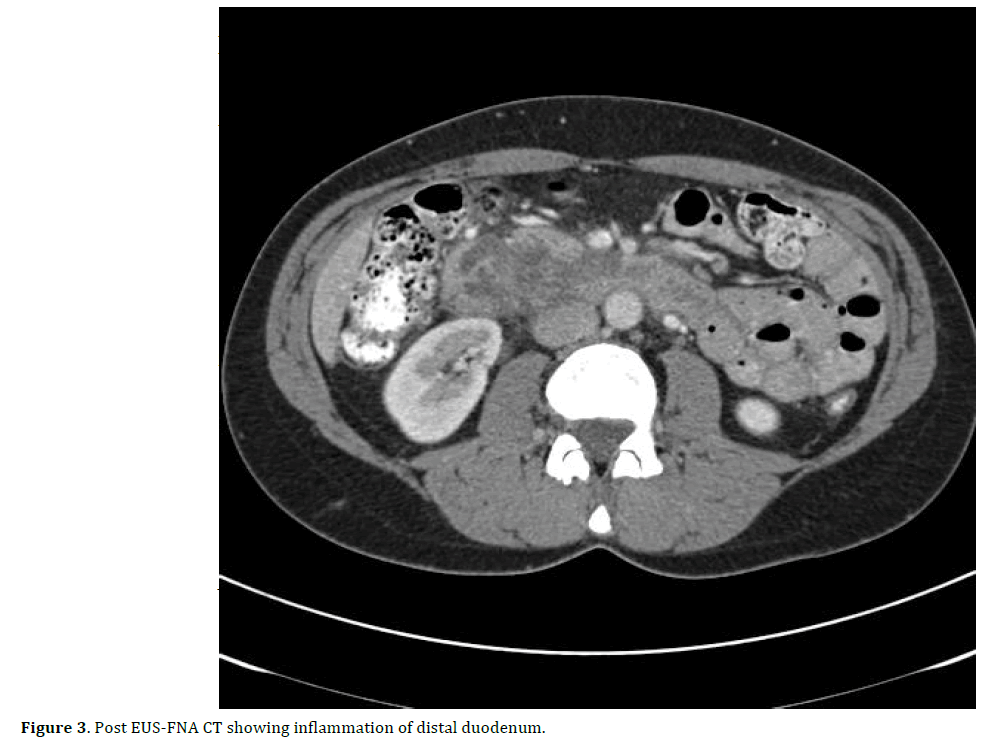 pancreas-Post-eus-fna-inflammation