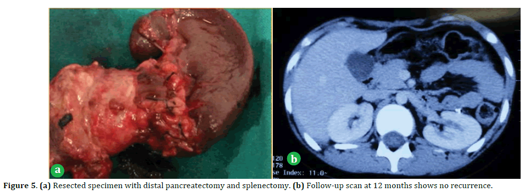 pancreas-Resected-specimen