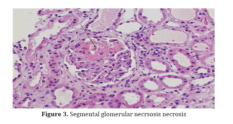 pancreas-Segmental-glomerular-necrsosis