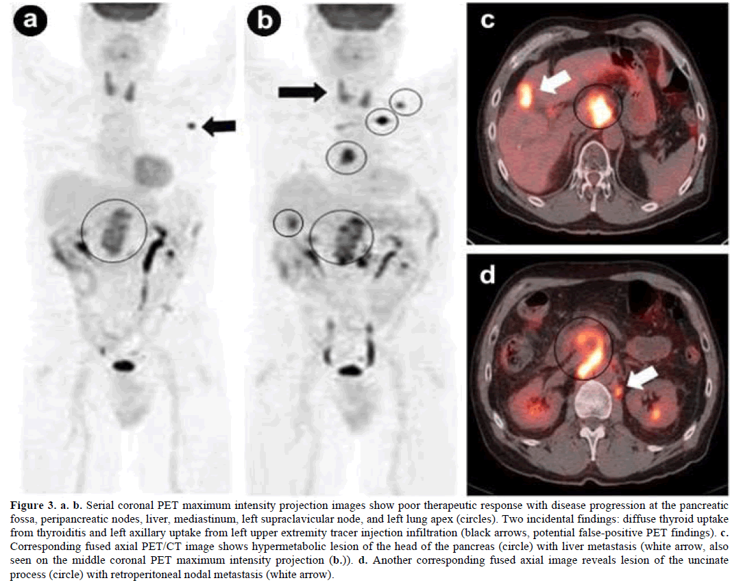 pancreas-Serial-coronal-maximum