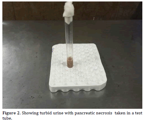 pancreas-Showing-turbid-urine-pancreatic