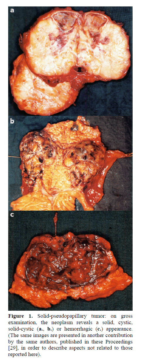 pancreas-Solid-pseudopapillary-tumor