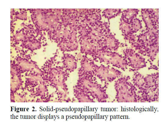 pancreas-Solid-pseudopapillary-tumor