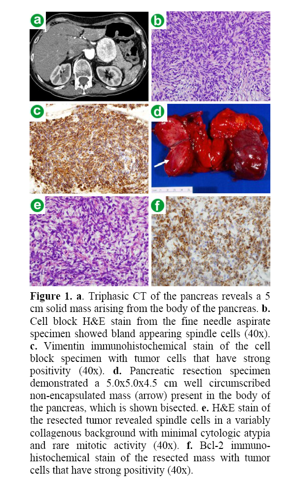 pancreas-Vimentin-immunohistochemical