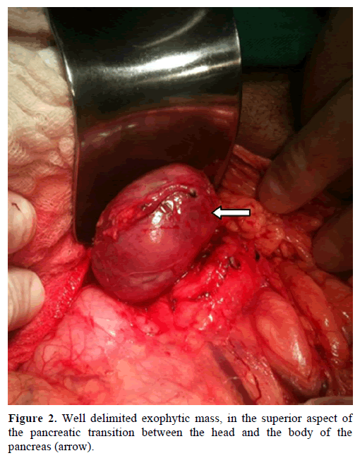 pancreas-Well-delimited-exophytic-mass