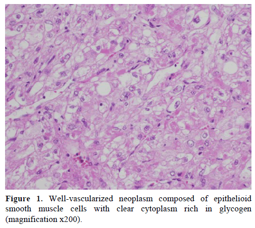 pancreas-Well-vascularized-neoplasm