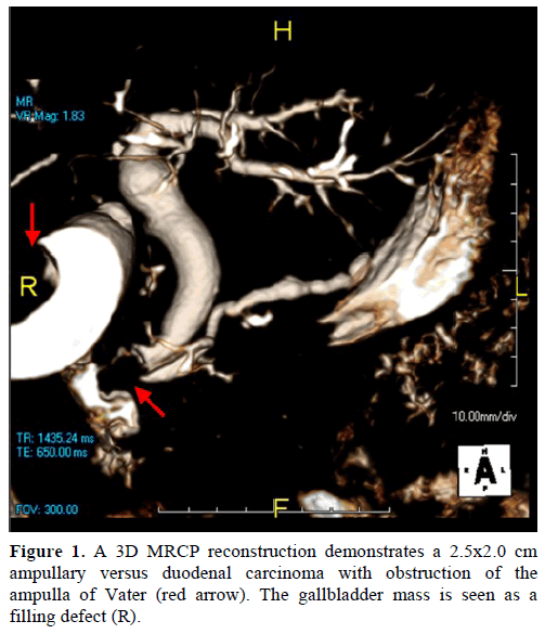 pancreas-a-3d-mrcp-reconstruction-demonstrates