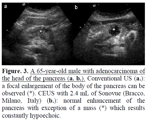 pancreas-a-65-year-old-male