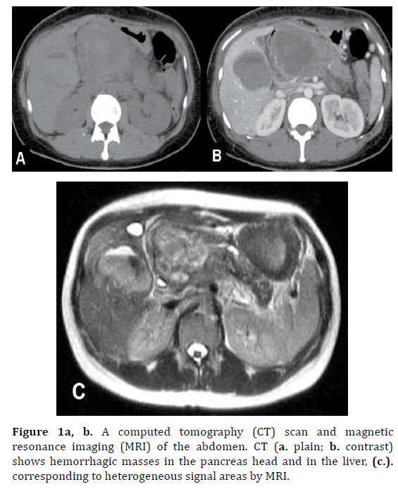 pancreas-a-computed-tomography