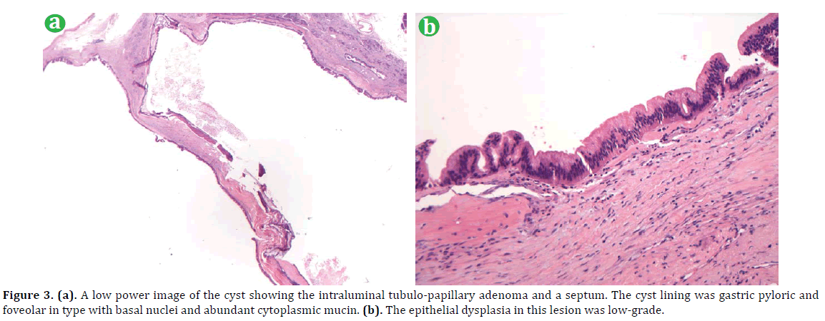 pancreas-a-low-power-image-cyst