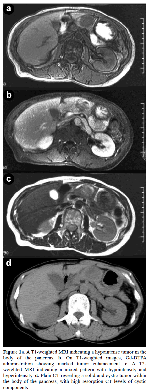 pancreas-a-t1-weighted-mri-tumor