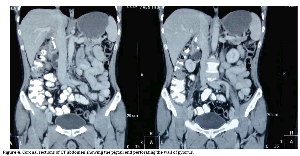 pancreas-abdomen
