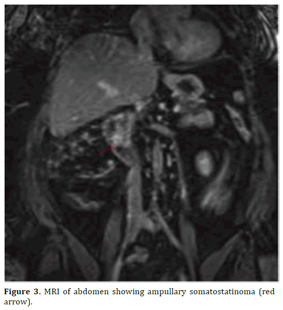 pancreas-abdomen-ampullary-somatostatinoma