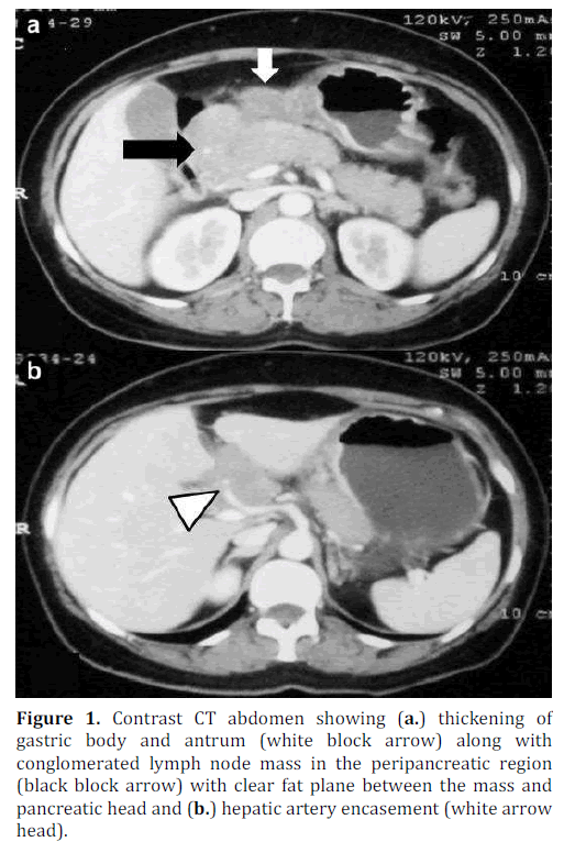 pancreas-abdomen-gastric-antrum